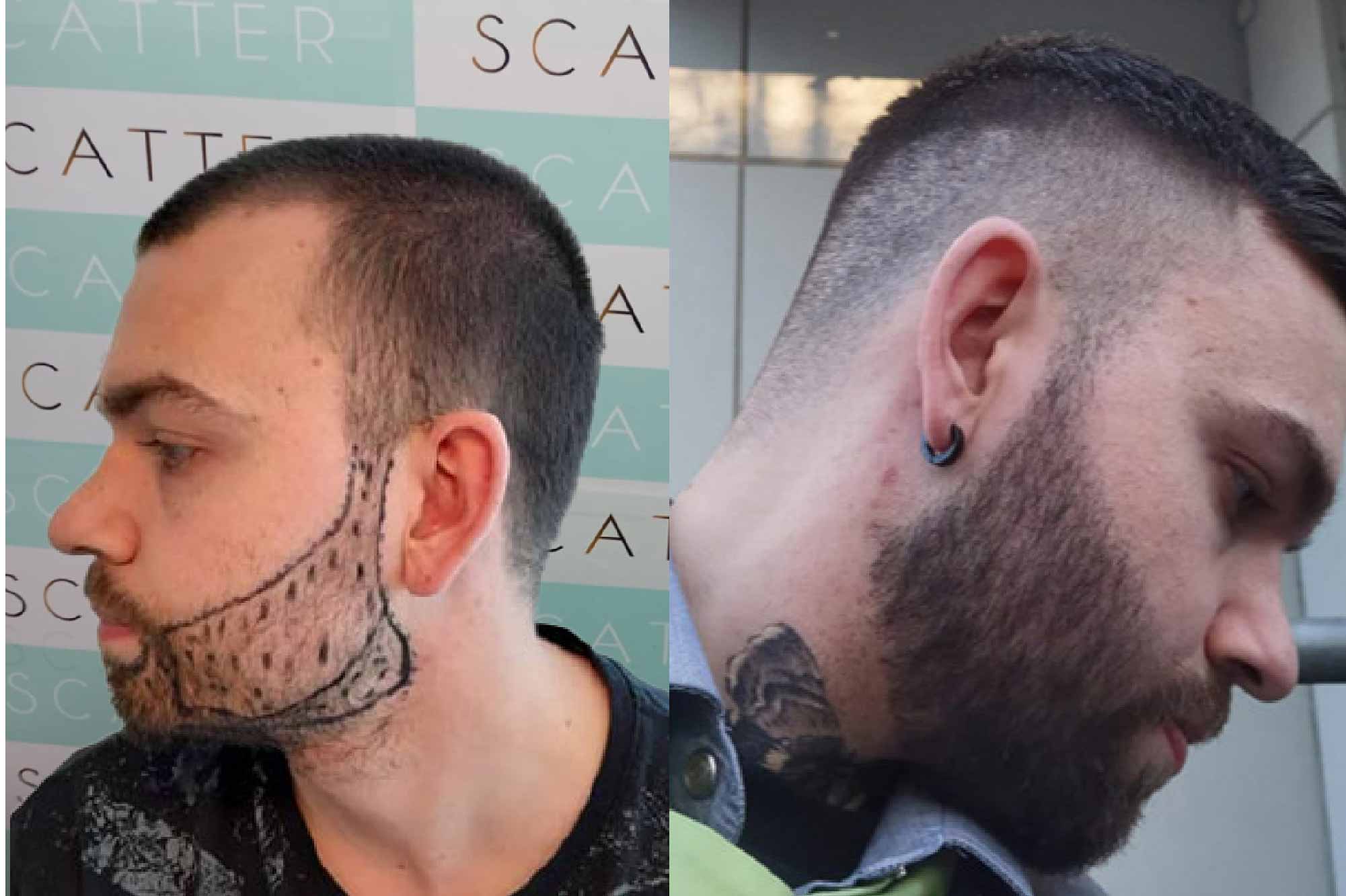 Trasplante de  Barba