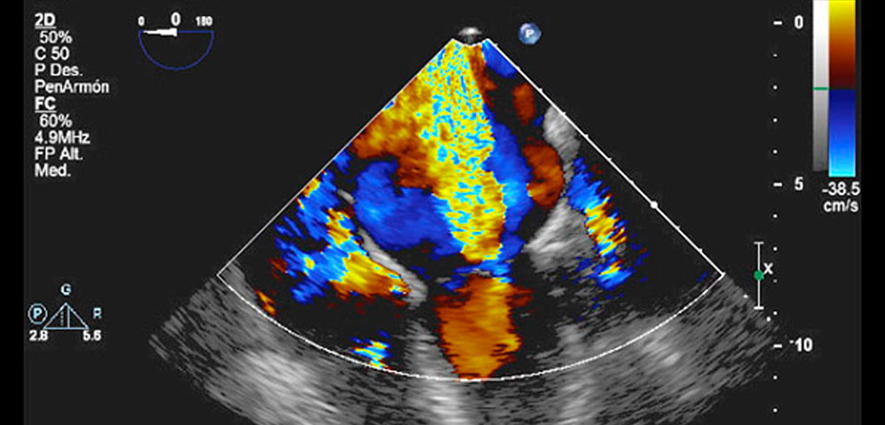 ECOCARDIOGRAMA DOPPLER 2D-FLUJO COLOR