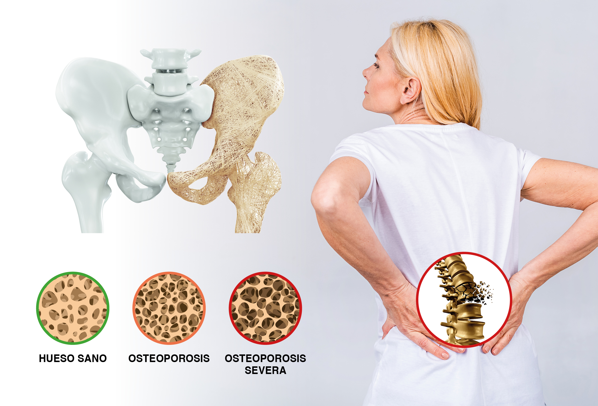 Tratamiento De Osteoporosis