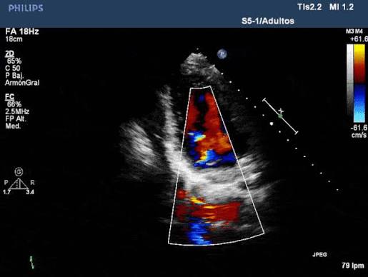 ECOCARDIOGRAMA DOPPLER 2D-FLUJO COLOR